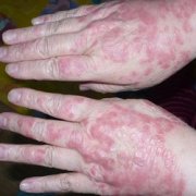 关节型牛皮癣的症状表现是什么样的