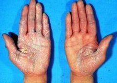 关节病型牛皮癣的症状是什么