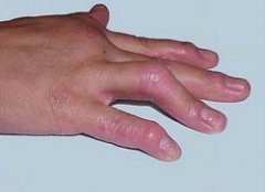 手部关节型牛皮癣的症状是怎样的