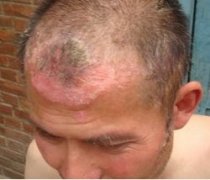 头上患了牛皮癣应该要怎么办