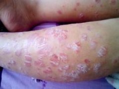 关节型牛皮癣的类型有哪几种